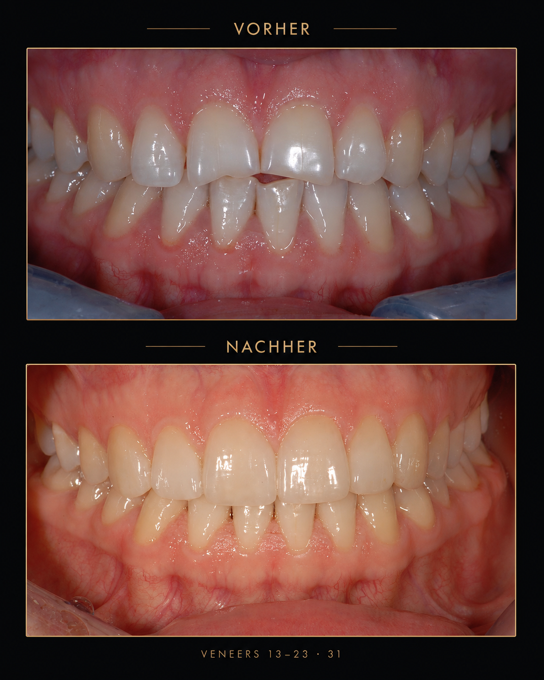 Weiteres Behandlungsbeispiel mit Veneers – vorher und nachher